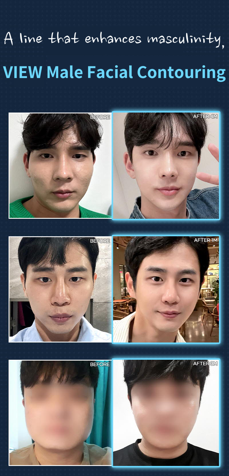 ❤️View❤️ Male Facial Contouring