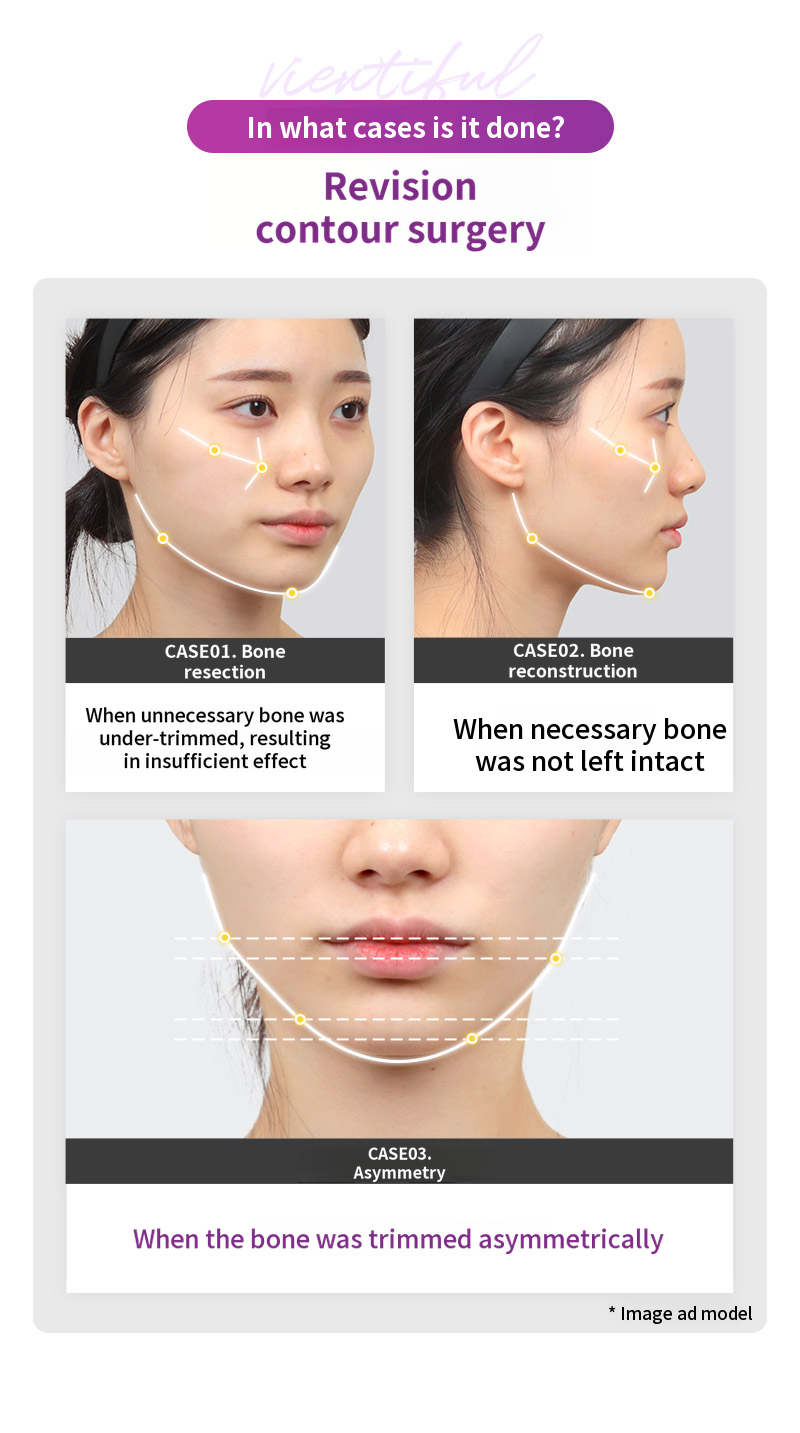 ❤️View❤️ Facial Contouring Revision Surgery