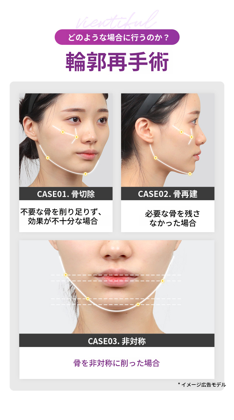 ❤️ビュー❤️フェイスライン再手術