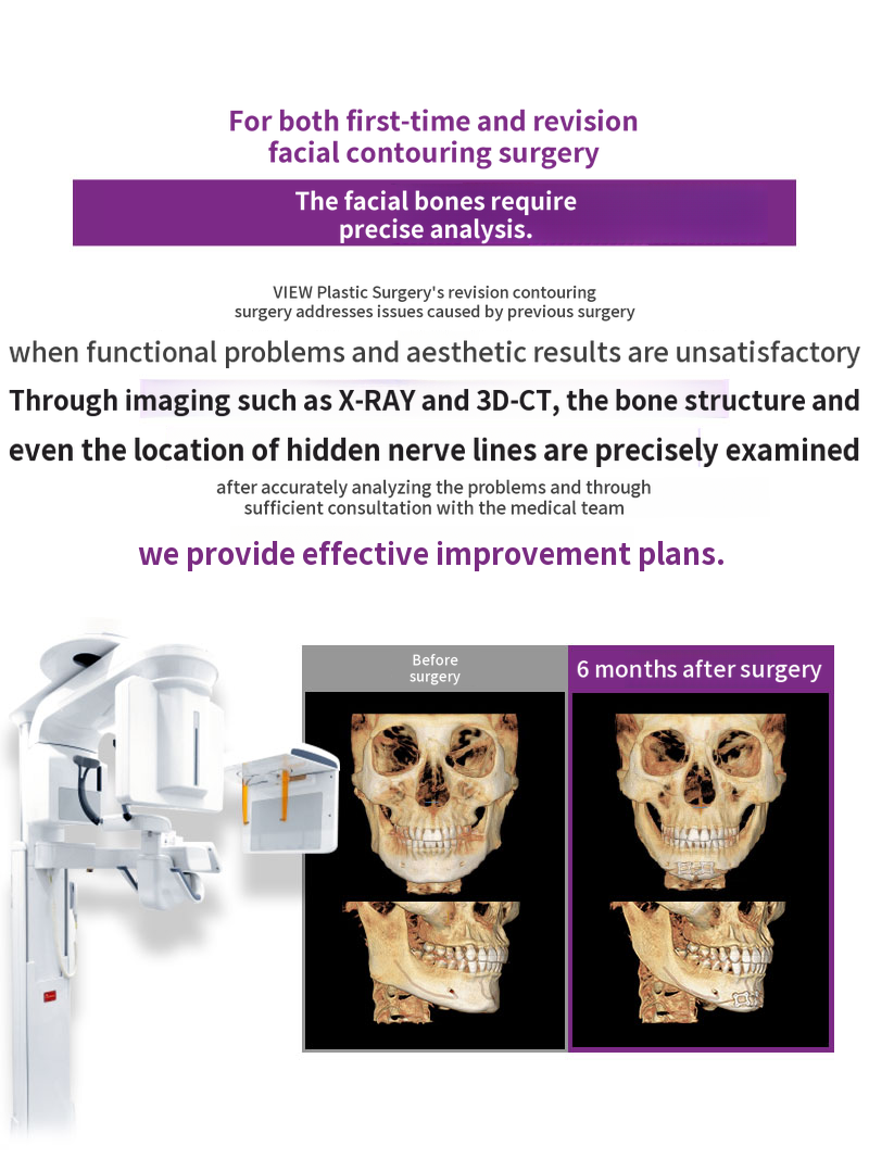 ❤️View❤️ Facial Contouring Revision Surgery