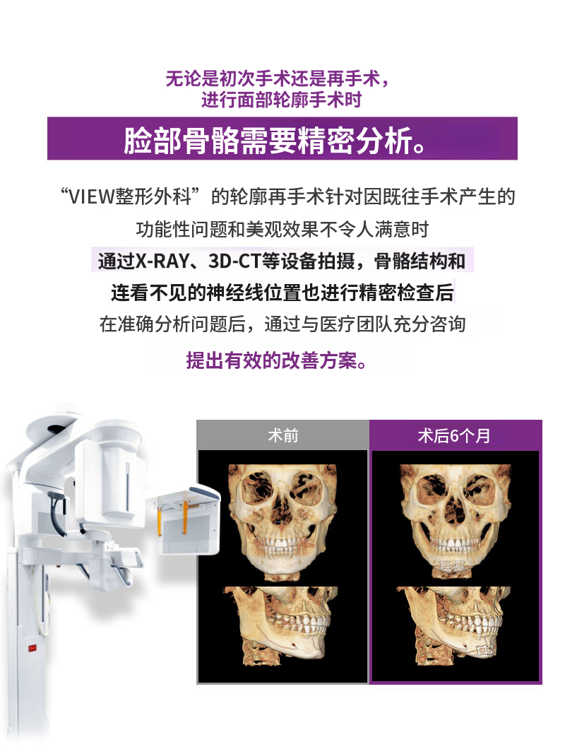 ❤️视图❤️面部轮廓修复手术
