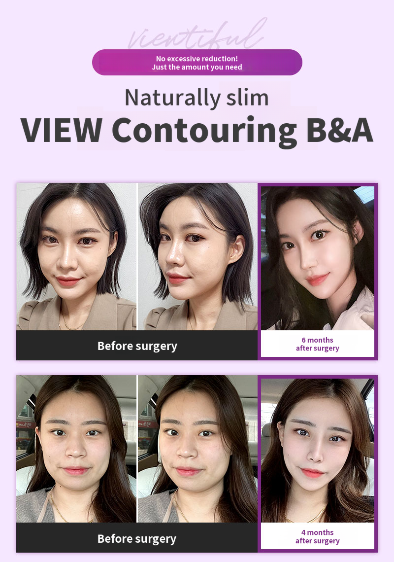 ❤️View❤️ Facial Contouring Revision Surgery