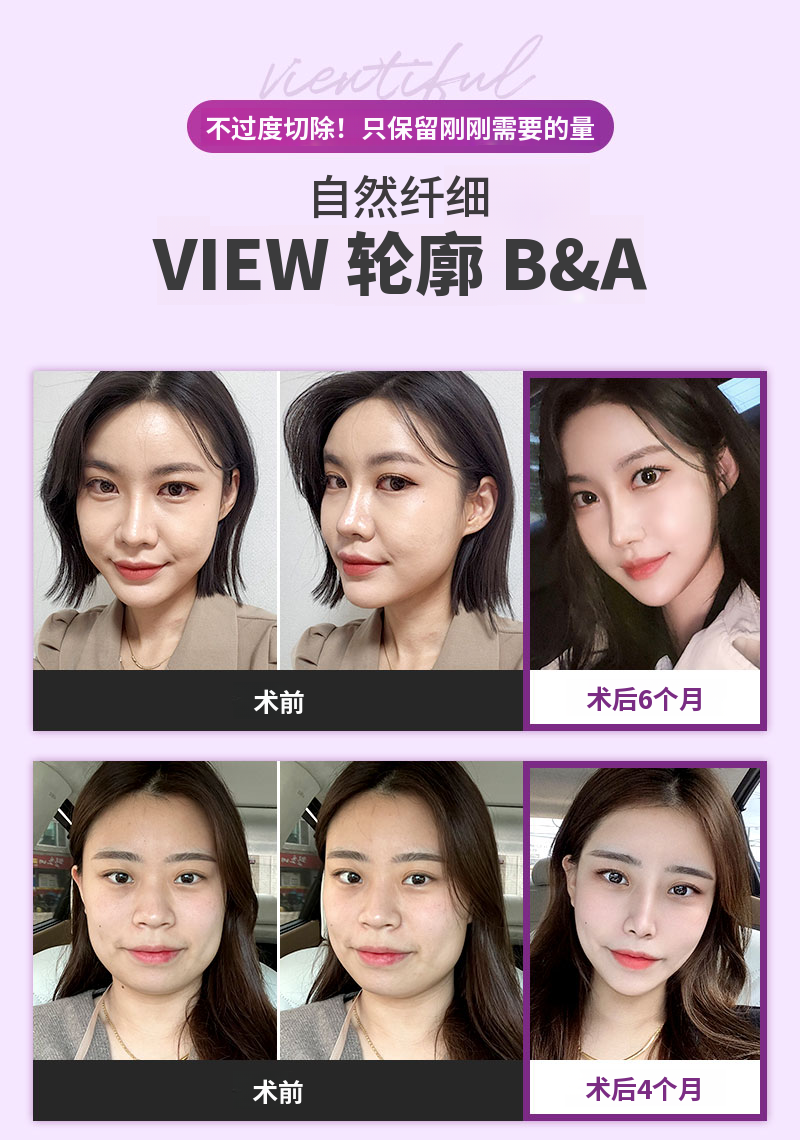 ❤️视图❤️面部轮廓修复手术