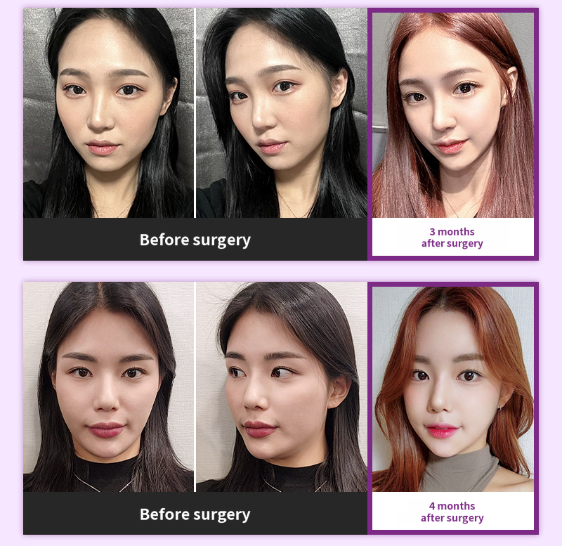 ❤️View❤️ Facial Contouring Revision Surgery