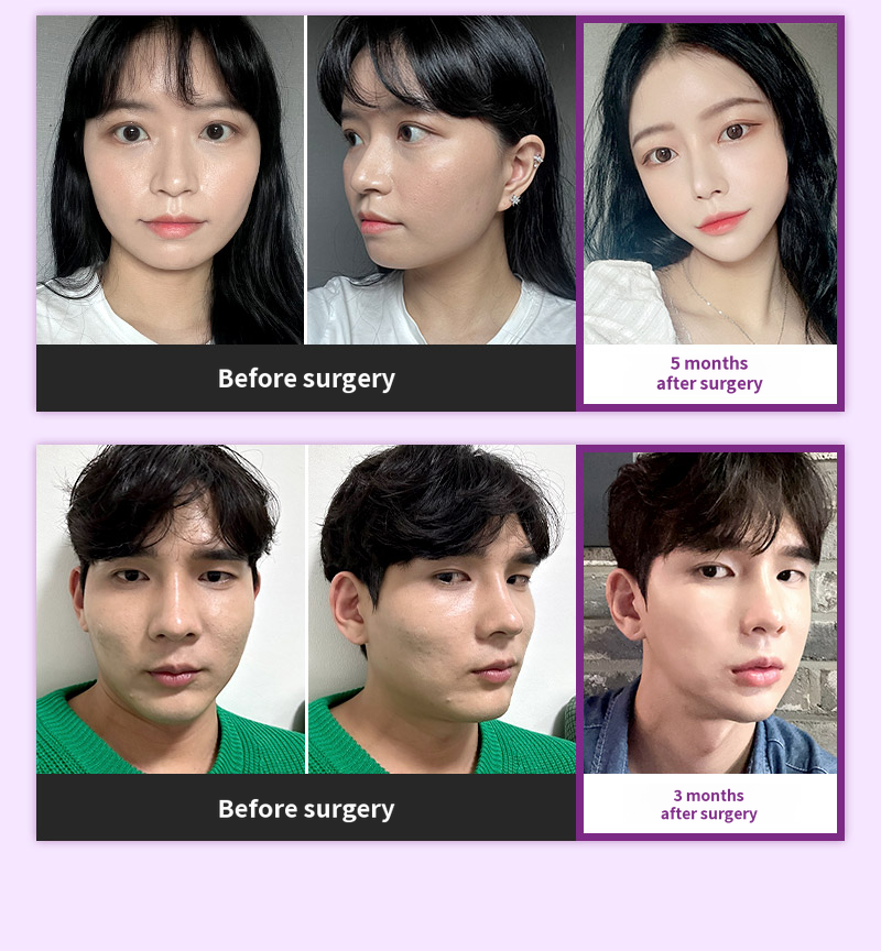 ❤️View❤️ Facial Contouring Revision Surgery