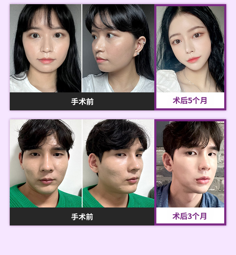 ❤️视图❤️面部轮廓修复手术