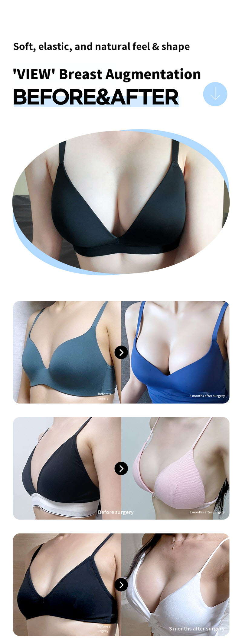 ❤️View❤️ Mentor Breast Augmentation