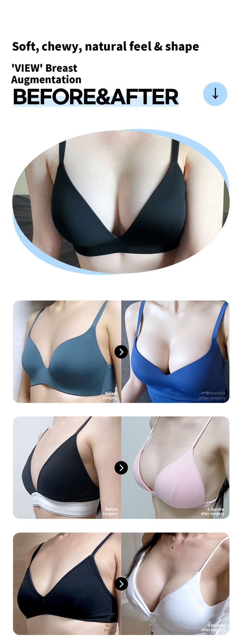 ❤️View❤️Mentor Breast Surgery