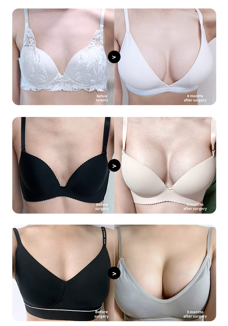 ❤️View❤️Mentor Breast Surgery