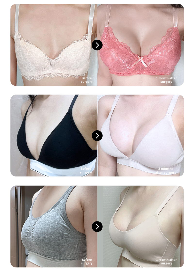 ❤️View❤️Mentor Breast Surgery