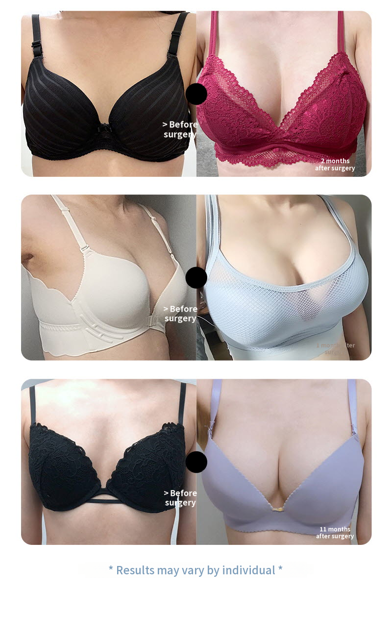 ❤️View❤️Mentor Breast Surgery