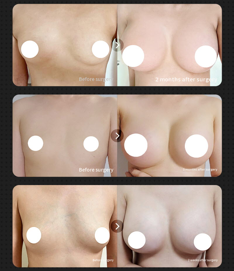 ❤️View❤️ Mentor Breast Augmentation