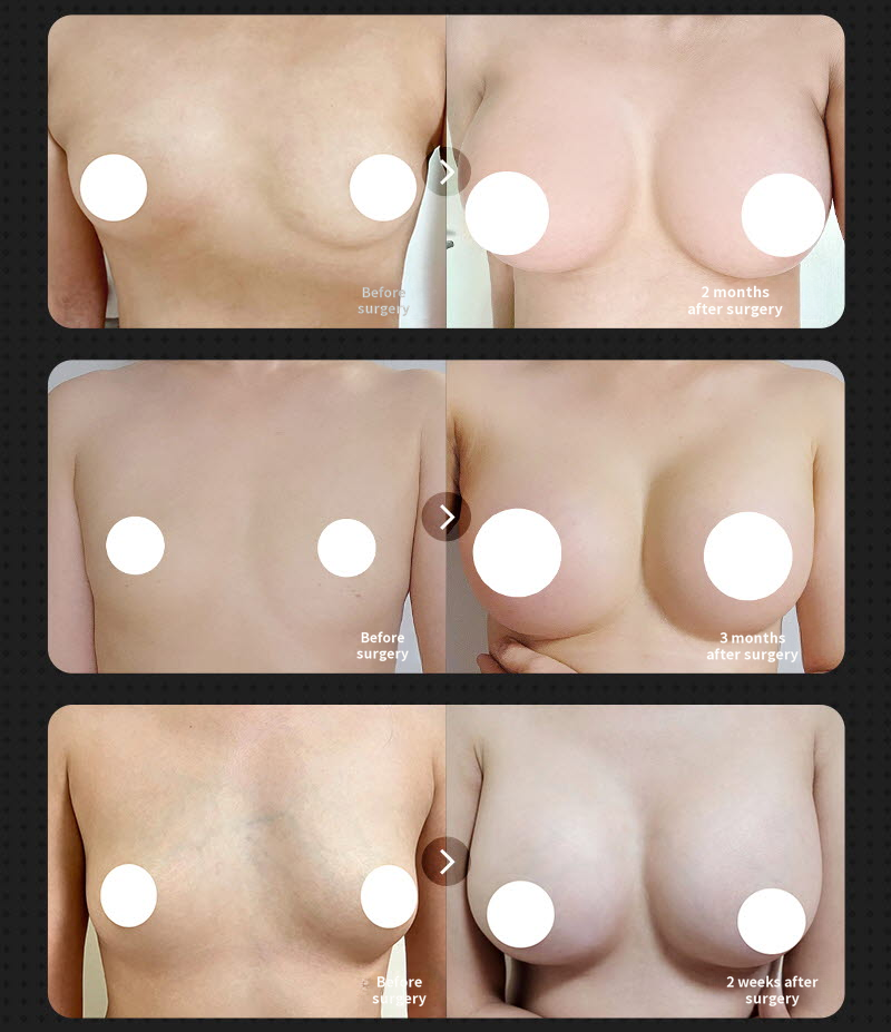 ❤️View❤️Mentor Breast Surgery