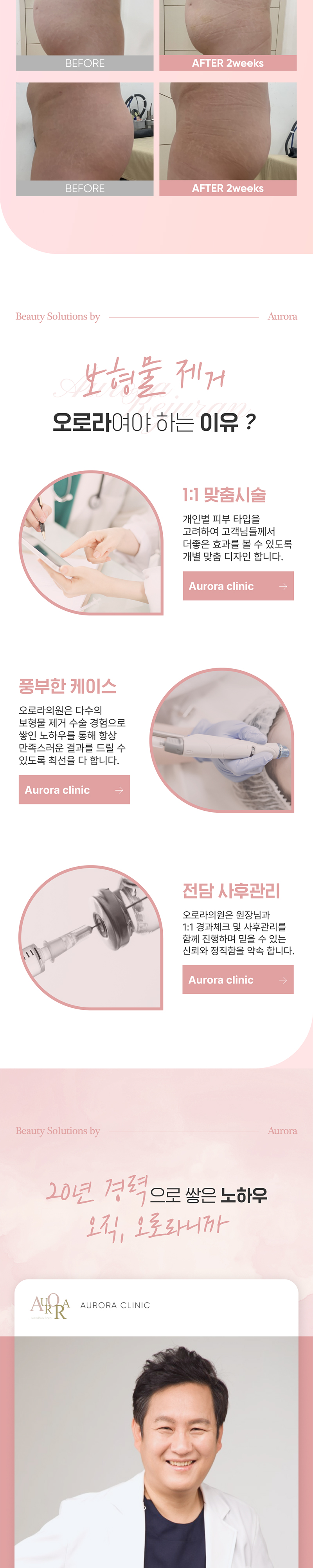 오로라의원 보형물&이물질제거 이벤트, 시술 상세 이미지