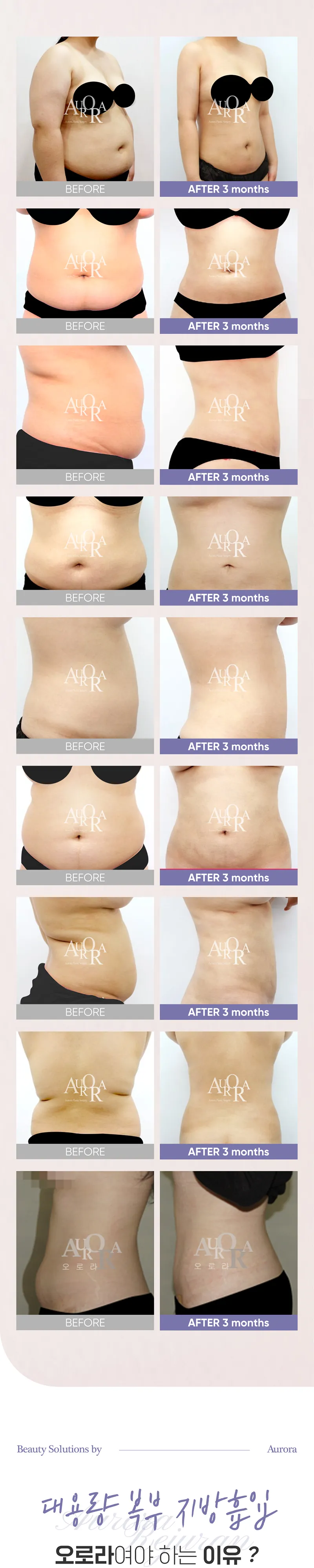 오로라의원  무제한 360도 복부 지방흡입 이벤트, 시술 상세 이미지