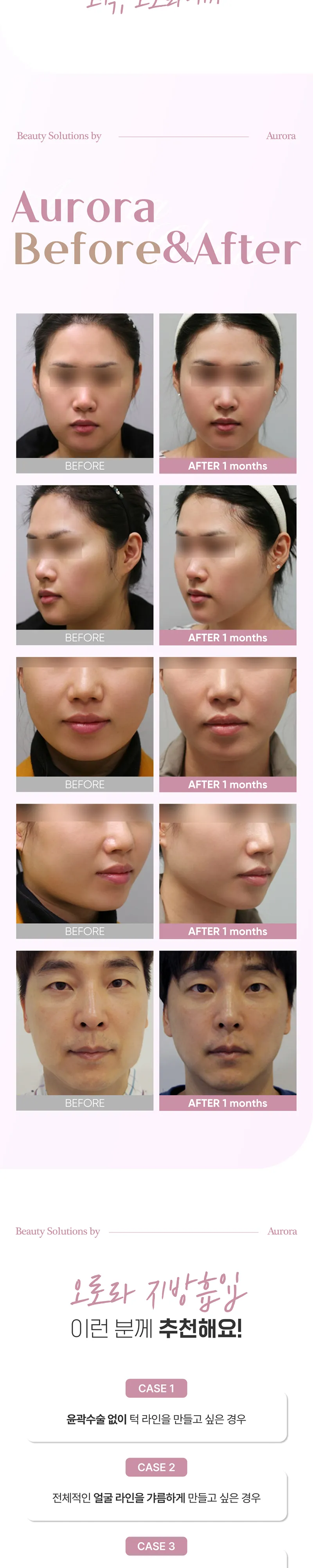 오로라의원 오로라 얼굴지방흡입 이벤트, 시술 상세 이미지