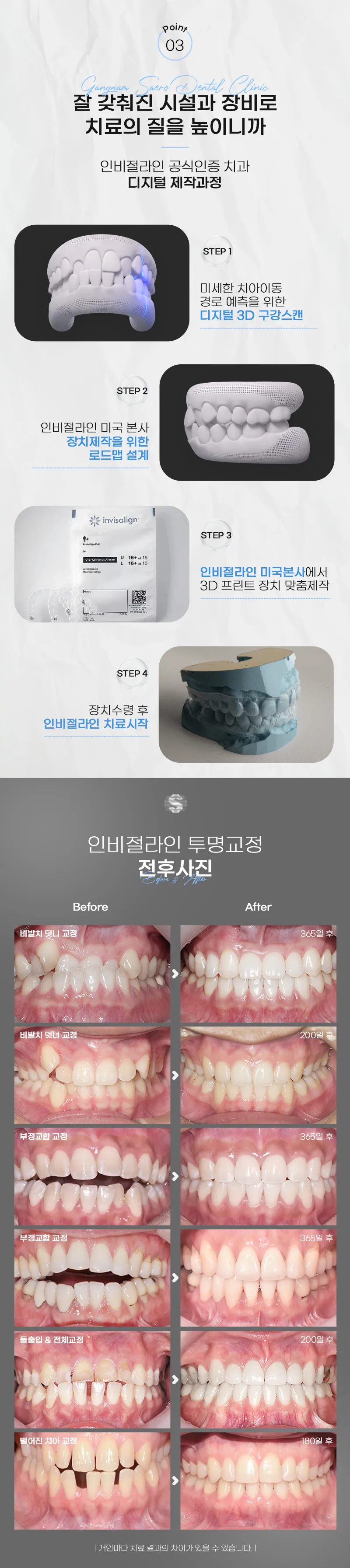 강남새로치과 똑똑한 선택 인비절라인 익스프레스 이벤트, 시술 상세 이미지