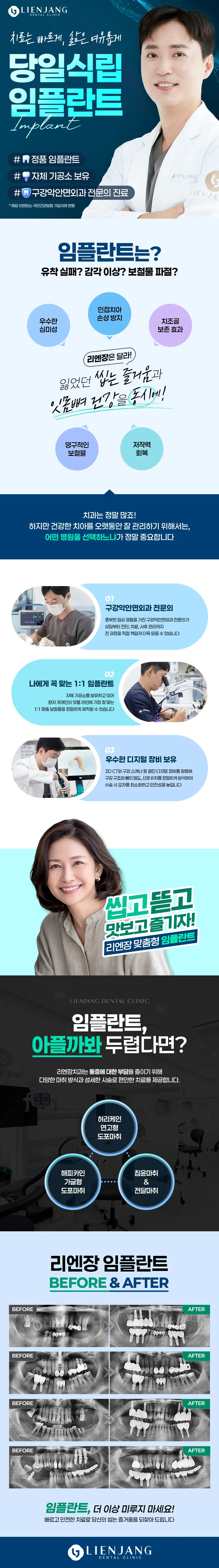 리엔장치과 씹고 뜯고 맛보고 즐기자! 리엔장 당일식립임플란트 이벤트, 시술 상세 이미지