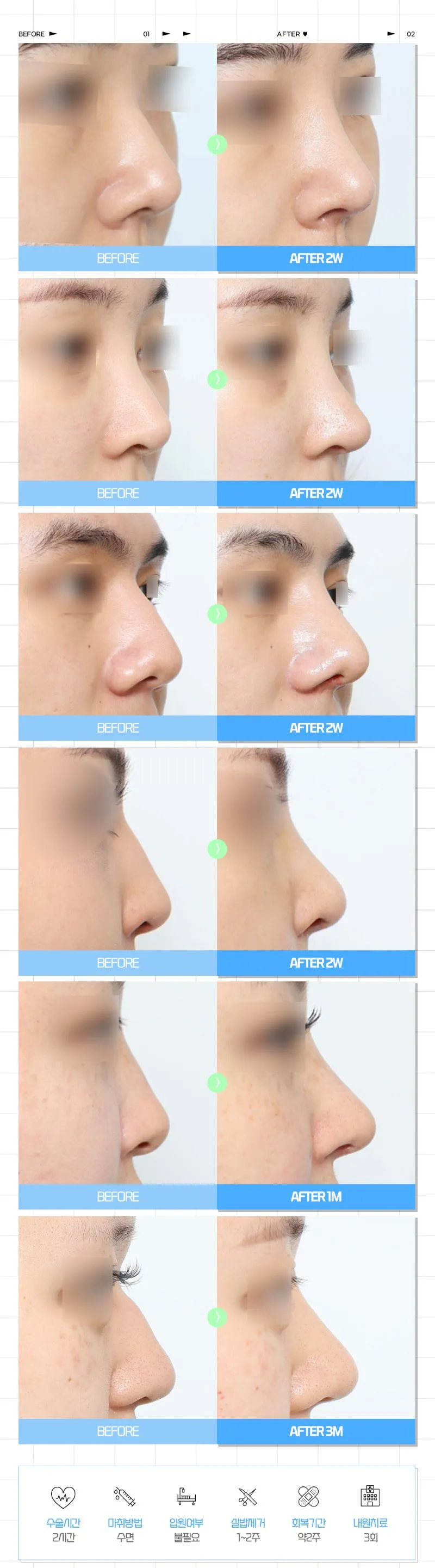 다비다성형외과의원 다비다 퓨어 첫코성형 이벤트, 시술 상세 이미지