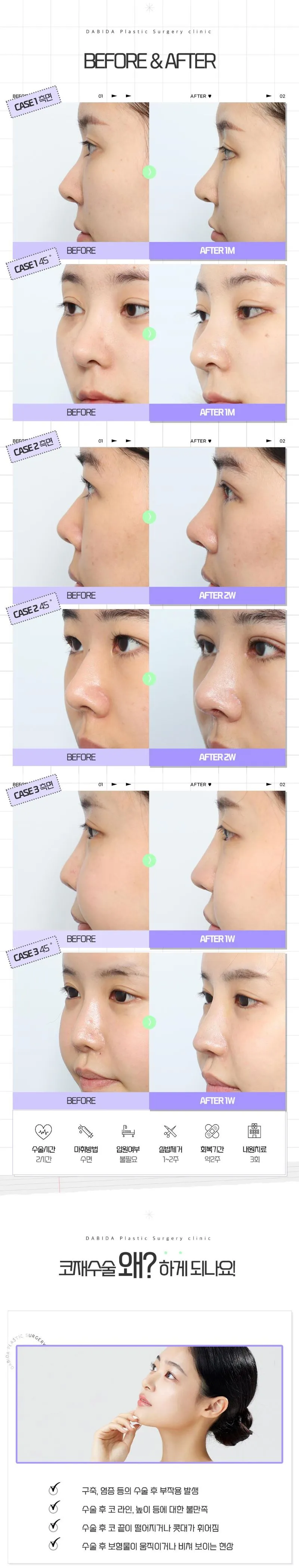 다비다성형외과의원 다비다 마지막 코재수술 이벤트, 시술 상세 이미지