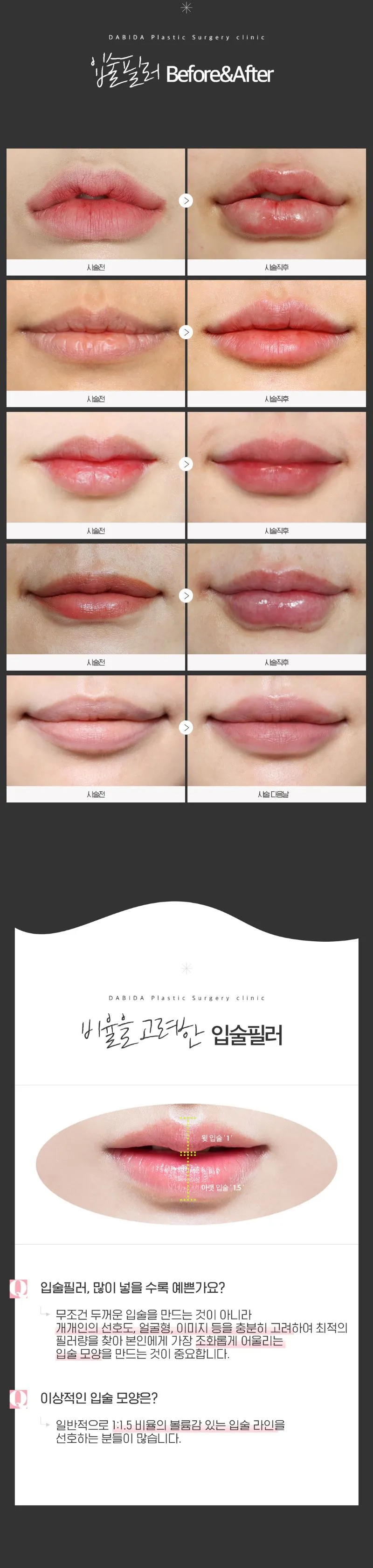 다비다성형외과의원 황금 비율 115 입술필러 이벤트, 시술 상세 이미지