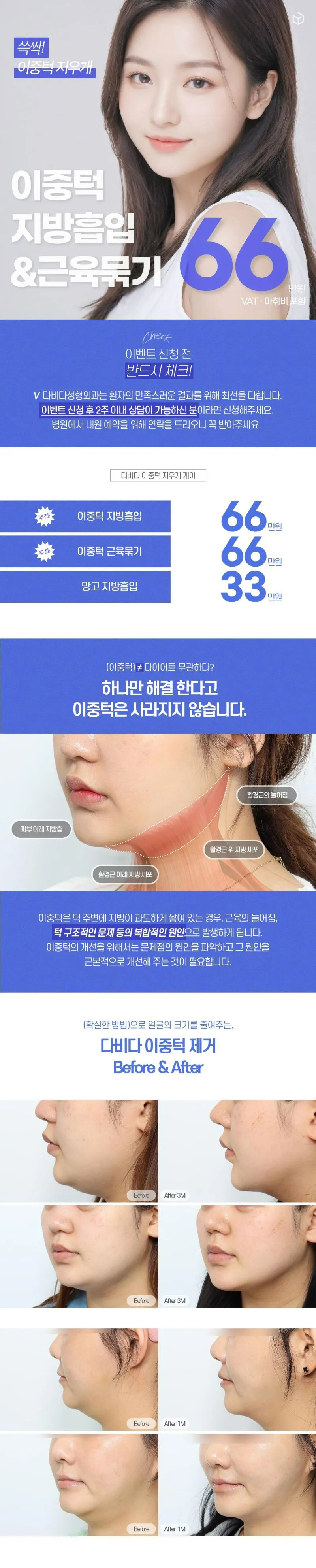 다비다성형외과의원 다비다 이중턱지우개 지방흡입&근육묶기 이벤트, 시술 상세 이미지