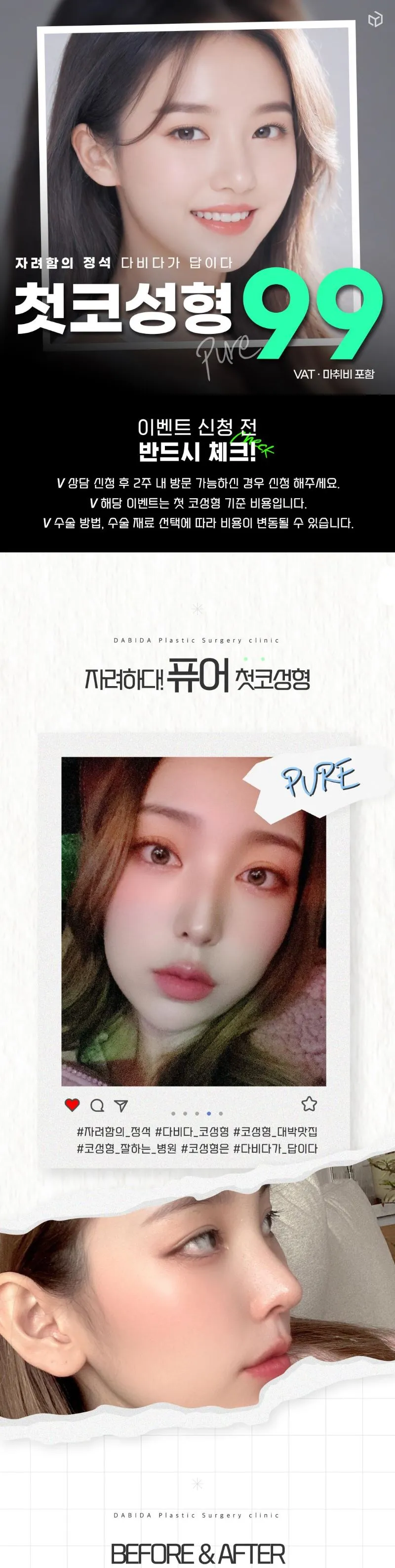 다비다성형외과의원 다비다 퓨어 첫코성형 이벤트, 시술 상세 이미지