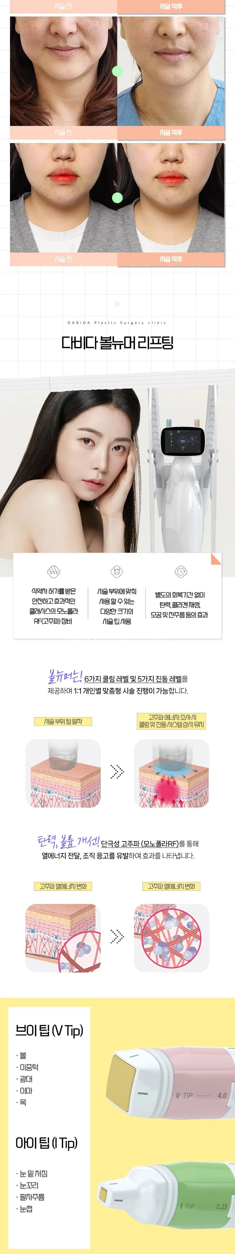 다비다성형외과의원 탄력 쫀쫀 볼뉴머리프팅 이벤트, 시술 상세 이미지