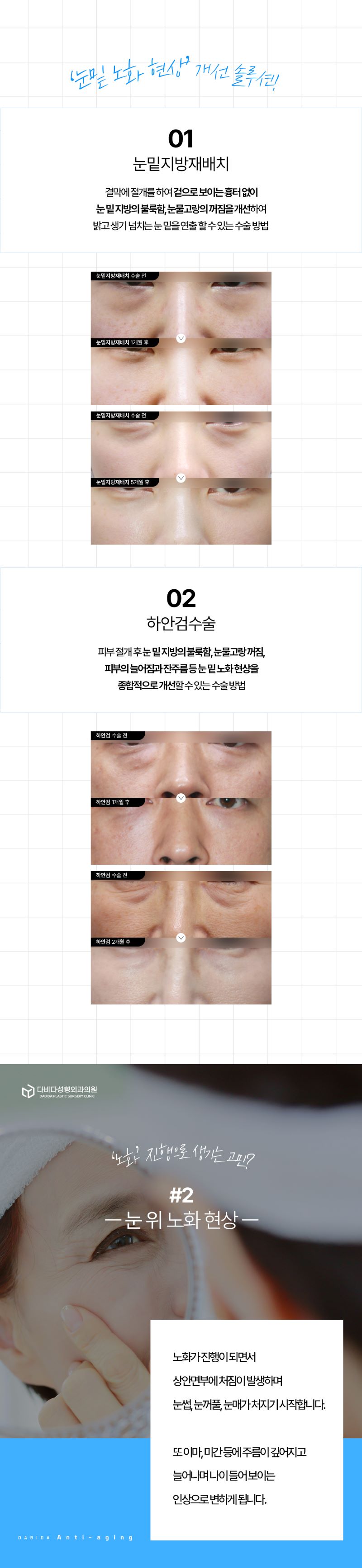 다비다성형외과의원 시간을 되돌리는 중년성형 이벤트, 시술 상세 이미지