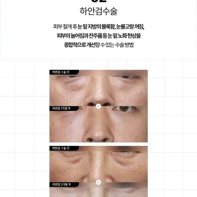 다비다성형외과의원 시간을 되돌리는 중년성형 이벤트, 시술 상세 이미지