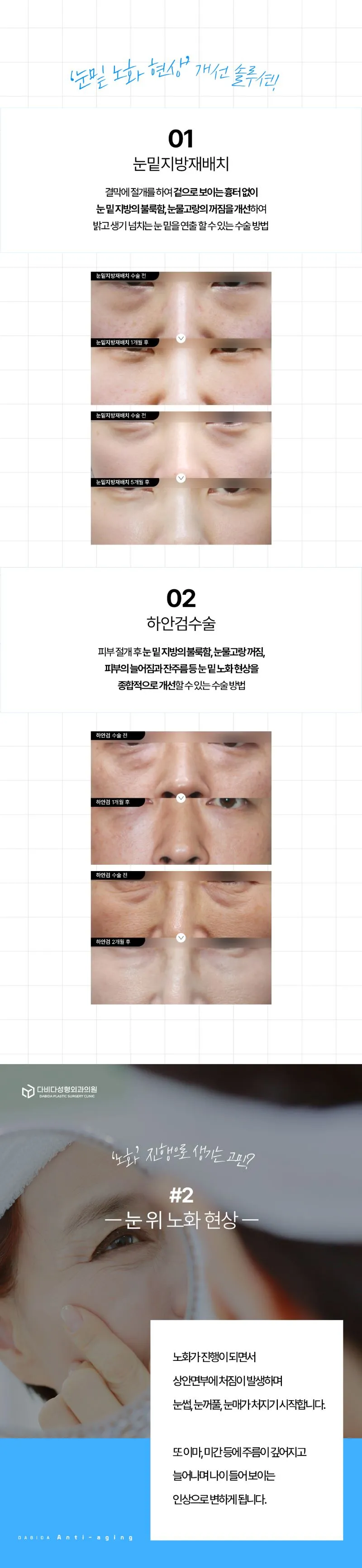 다비다성형외과의원 시간을 되돌리는 중년성형 이벤트, 시술 상세 이미지