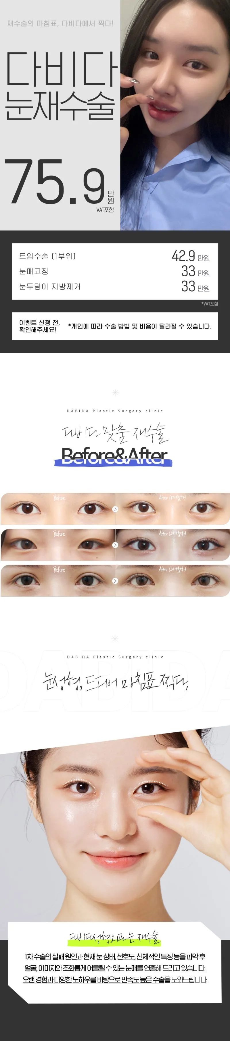 다비다성형외과의원 재수술 마침표 쌍꺼풀재수술 이벤트, 시술 상세 이미지