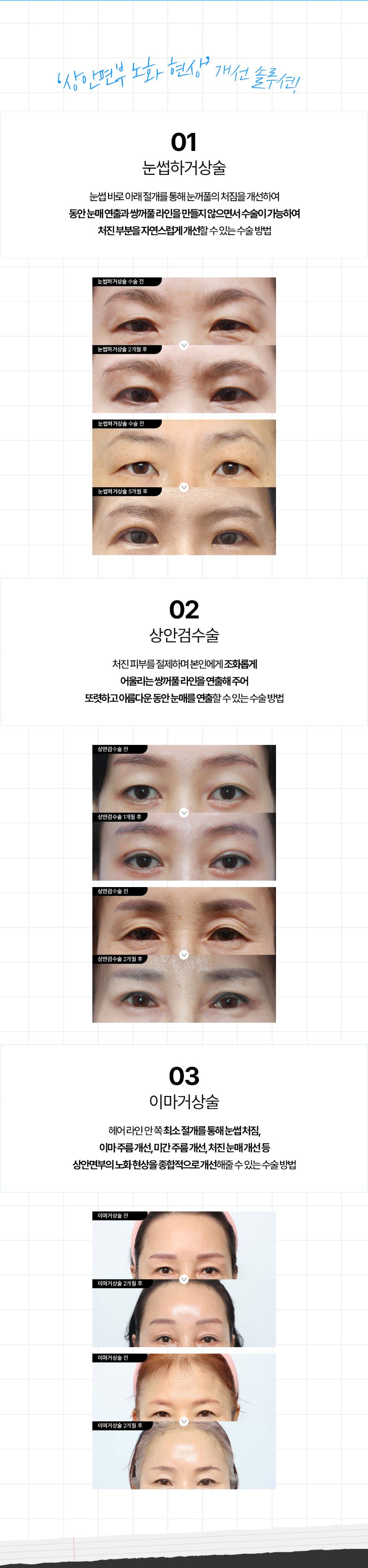 다비다성형외과의원 시간을 되돌리는 중년성형 이벤트, 시술 상세 이미지