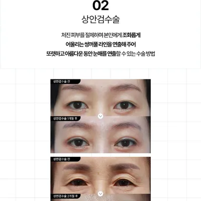 다비다성형외과의원 시간을 되돌리는 중년성형 이벤트, 시술 상세 이미지