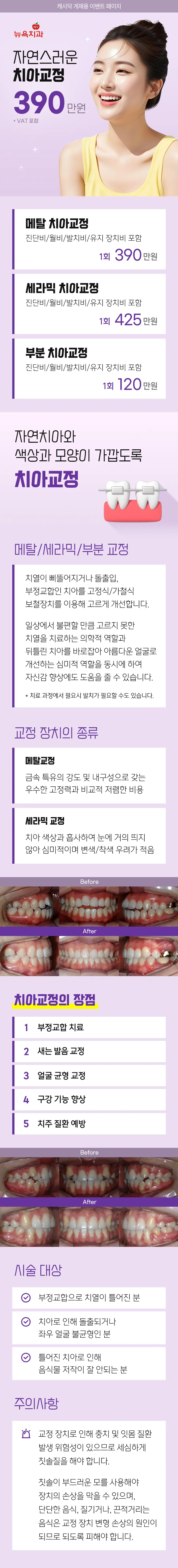 뉴욕치과의원 자연스러운 치아교정 이벤트, 시술 상세 이미지