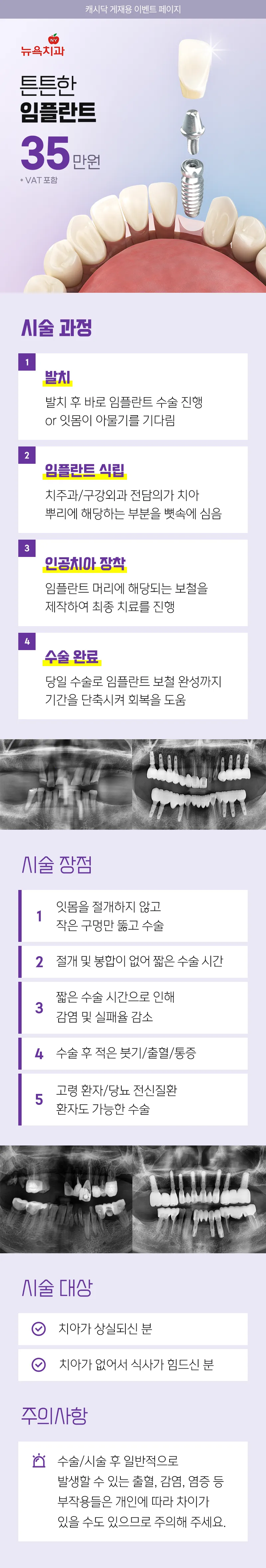 뉴욕치과의원 튼튼한 임플란트 이벤트, 시술 상세 이미지
