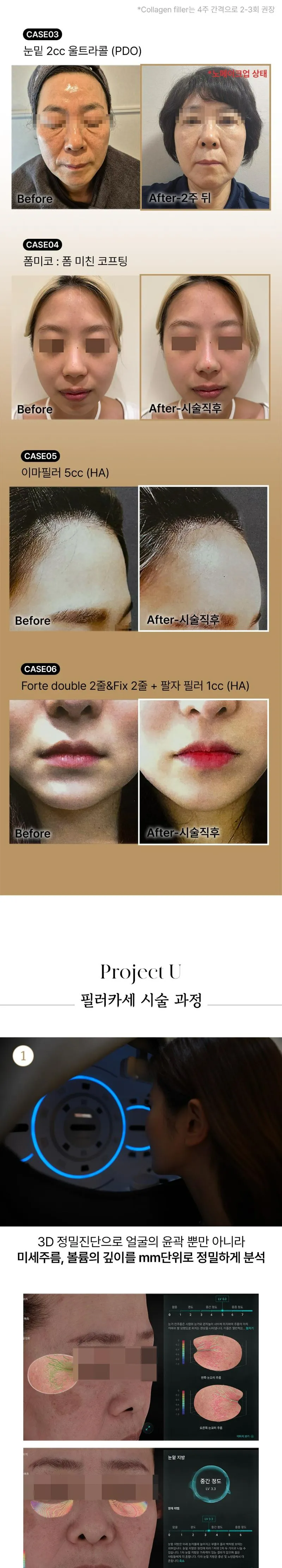 프로젝트유의원 💎필러카세💎대표원장 직접시술 이벤트, 시술 상세 이미지