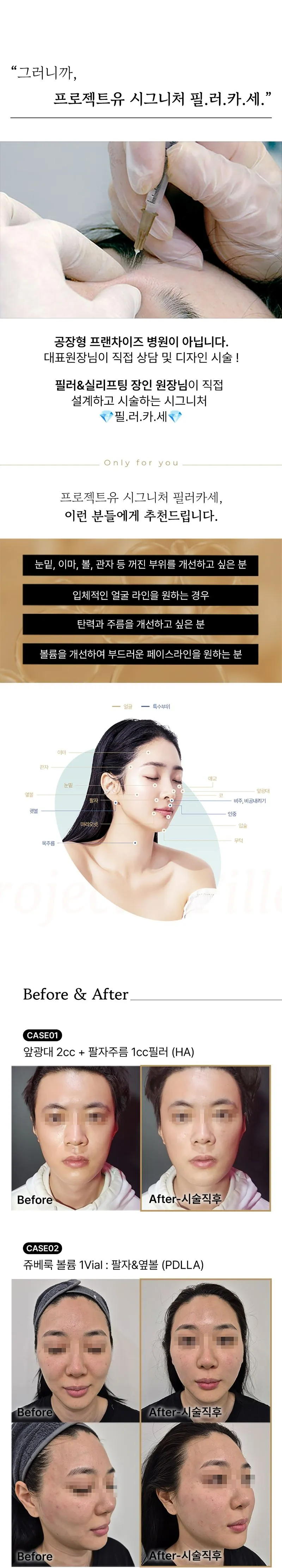 프로젝트유의원 💎필러카세💎대표원장 직접시술 이벤트, 시술 상세 이미지