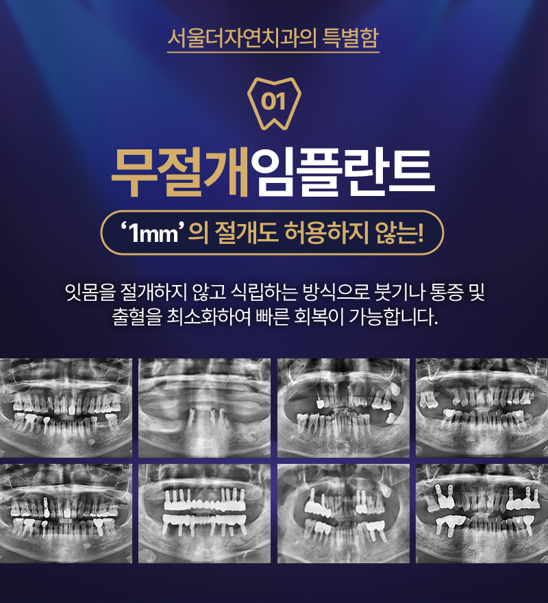 서울더자연치과 최소절개,빠른회복 서울더자연임플란트 이벤트, 시술 상세 이미지
