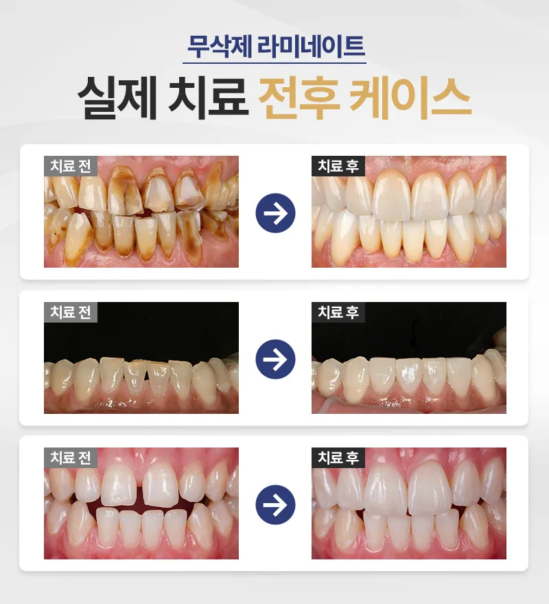 서울더자연치과 자연스러운 아름다움, 무삭제라미네이트 이벤트, 시술 상세 이미지