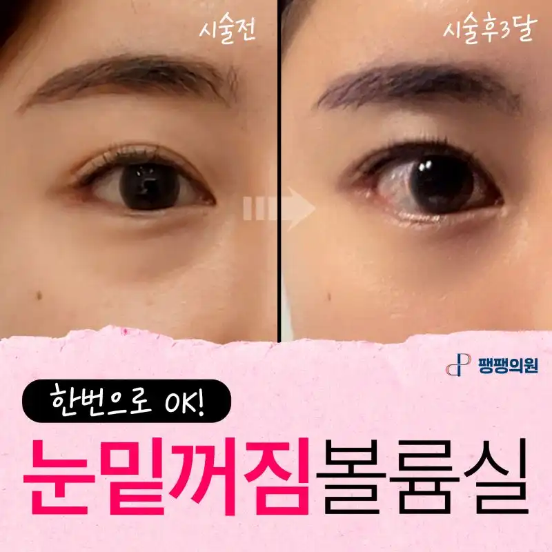 눈밑볼륨👀 채우는 실리프팅