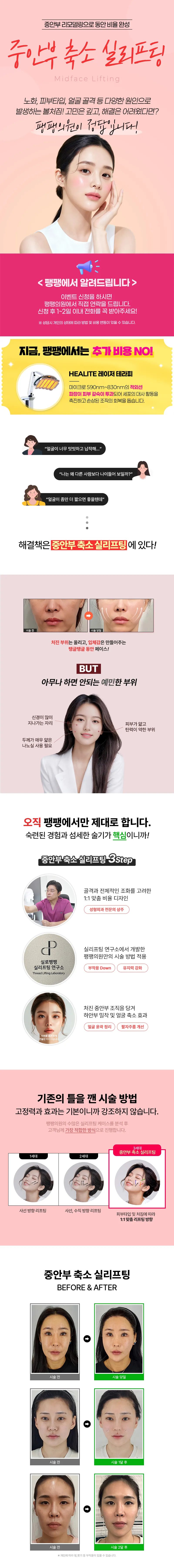팽팽의원 긴 얼굴 모여! 중안부 축소 실리프팅 이벤트, 시술 상세 이미지