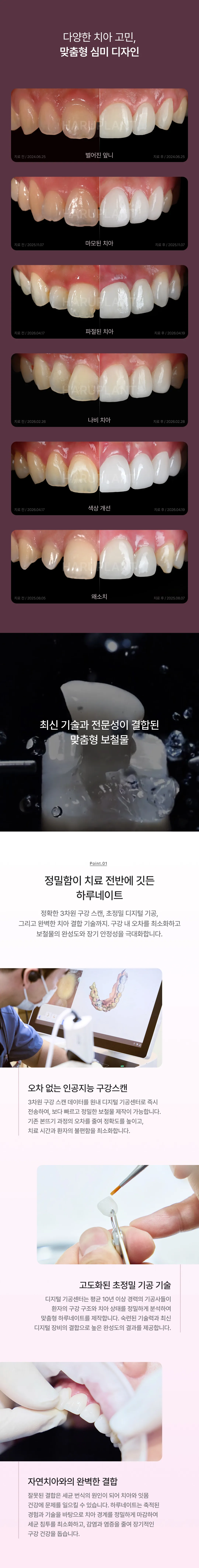 【 No-Prep Dental Veneers: KRW 390,000 】