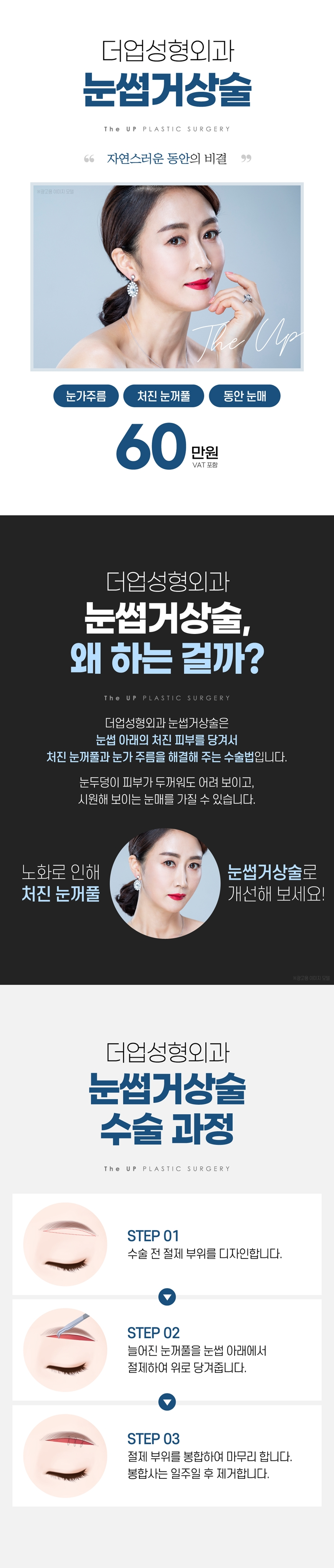 더업성형외과의원 처진 눈매 UP! 눈썹거상술 이벤트, 시술 상세 이미지