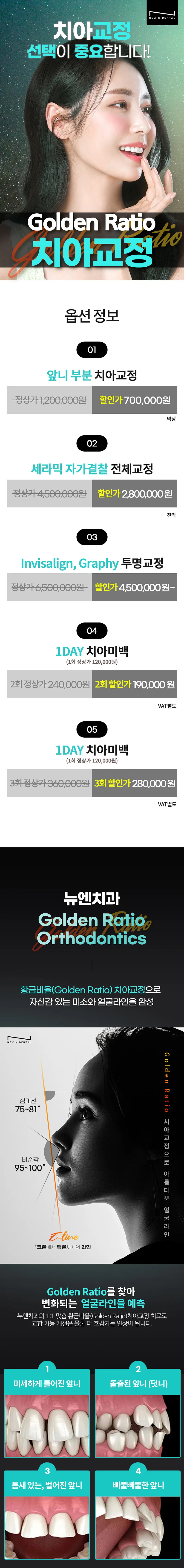 뉴엔치과의원 GoldenRatio 황금비율치아교정 이벤트, 시술 상세 이미지