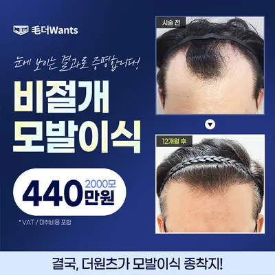 흉터 최소화, 비절개 모발이식 이벤트 썸네일 이미지