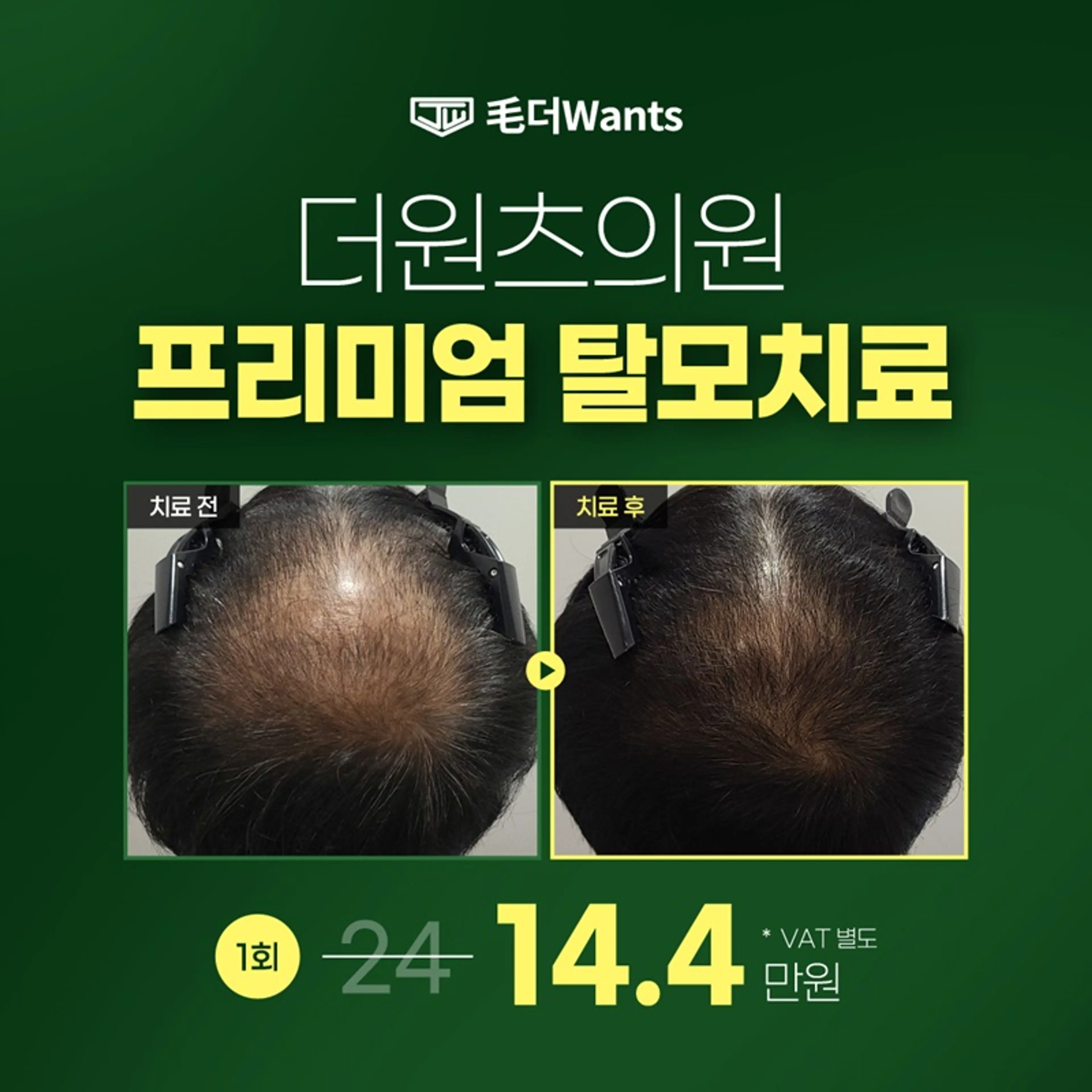 프리미엄 탈모치료♥