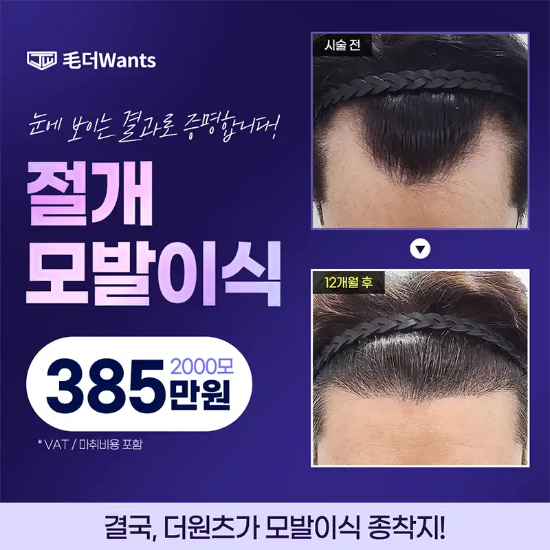 자연스러운 절개 모발이식 2000모