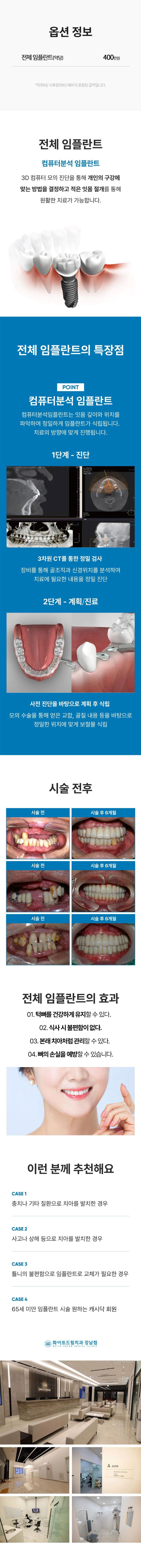 화이트드림치과 잇몸이 건강한 전체임플란트 이벤트, 시술 상세 이미지