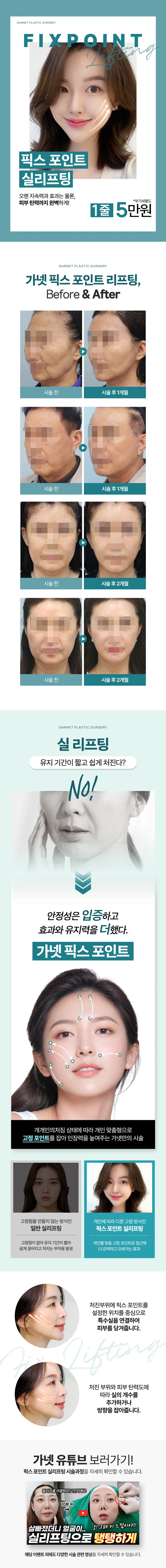 가넷성형외과의원 리프팅의 시작, 픽스포인트 실 리프팅 이벤트, 시술 상세 이미지